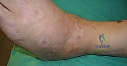 صورة طبية: تثبيت مفصل الكاحل الأمامي: حل فعال لخشونة الكاحل المزمنة مع الأستاذ الدكتور محمد هطيف