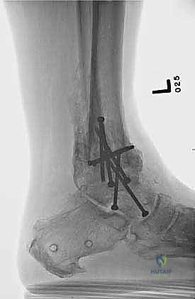 صورة طبية: تثبيت مفصل الكاحل الأمامي: حل فعال لخشونة الكاحل المزمنة مع الأستاذ الدكتور محمد هطيف