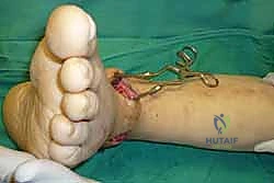 صورة طبية: تثبيت مفصل الكاحل الأمامي: حل فعال لخشونة الكاحل المزمنة مع الأستاذ الدكتور محمد هطيف