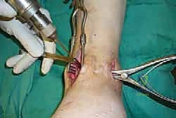 صورة طبية: تثبيت مفصل الكاحل الأمامي: حل فعال لخشونة الكاحل المزمنة مع الأستاذ الدكتور محمد هطيف