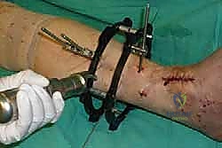 صورة طبية: تثبيت مفصل الكاحل الأمامي: حل فعال لخشونة الكاحل المزمنة مع الأستاذ الدكتور محمد هطيف