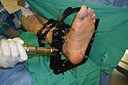 صورة طبية: تثبيت مفصل الكاحل الأمامي: حل فعال لخشونة الكاحل المزمنة مع الأستاذ الدكتور محمد هطيف