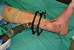 صورة طبية: تثبيت مفصل الكاحل الأمامي: حل فعال لخشونة الكاحل المزمنة مع الأستاذ الدكتور محمد هطيف