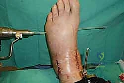 صورة طبية: تثبيت مفصل الكاحل الأمامي: حل فعال لخشونة الكاحل المزمنة مع الأستاذ الدكتور محمد هطيف