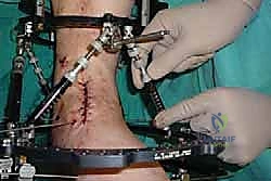 صورة طبية: تثبيت مفصل الكاحل الأمامي: حل فعال لخشونة الكاحل المزمنة مع الأستاذ الدكتور محمد هطيف