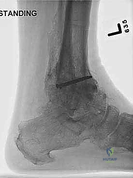 Illustration of proximal ring block - Dr. Mohammed Hutaif