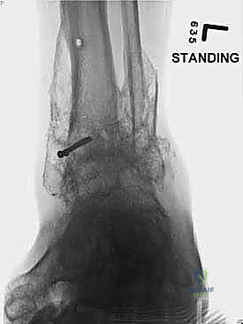 صورة طبية: تثبيت مفصل الكاحل الأمامي: حل فعال لخشونة الكاحل المزمنة مع الأستاذ الدكتور محمد هطيف