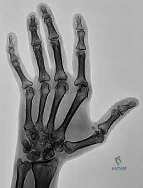 صورة أشعة سينية تظهر التآكل والانحراف الزندي لمفاصل MCP