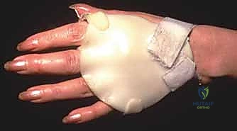 صورة طبية: استئصال الغشاء الزليلي وتوسيط الوتر الباسط لمفصل MCP: حل فعال لالتهاب المفاصل الروماتويدي في اليد