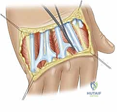 صورة توضيحية لـ استئصال الغشاء الزليلي وتوسيط الوتر الباسط لمفصل MCP: حل فعال لالتهاب المفاصل الروماتويدي في اليد