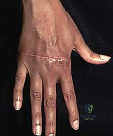 صورة طبية: استئصال الغشاء الزليلي وتوسيط الوتر الباسط لمفصل MCP: حل فعال لالتهاب المفاصل الروماتويدي في اليد