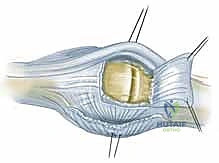 صورة توضيحية لـ استئصال الغشاء الزليلي وتوسيط الوتر الباسط لمفصل MCP: حل فعال لالتهاب المفاصل الروماتويدي في اليد