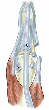 صورة توضيحية لـ استئصال الغشاء الزليلي وتوسيط الوتر الباسط لمفصل MCP: حل فعال لالتهاب المفاصل الروماتويدي في اليد