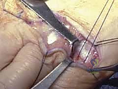 صورة طبية: استئصال الغشاء الزليلي وتوسيط الوتر الباسط لمفصل MCP: حل فعال لالتهاب المفاصل الروماتويدي في اليد