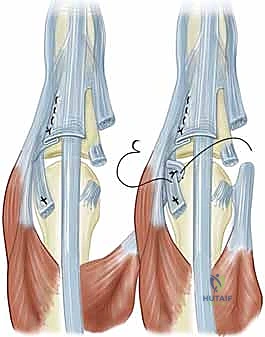 تآكل الغضاريف وتكوين السبلة الروماتويدية