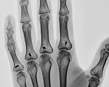 صورة طبية: استئصال الغشاء الزليلي وتوسيط الوتر الباسط لمفصل MCP: حل فعال لالتهاب المفاصل الروماتويدي في اليد