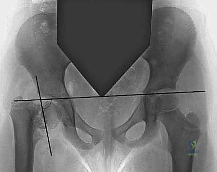 Illustration of developmental coxa vara - Dr. Mohammed Hutaif