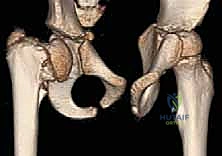 صورة توضيحية لـ الفحج الرضخي النمائي عند الأطفال: دليل شامل للتشخيص والعلاج بتقويم الفحج مع الأستاذ الدكتور محمد هطيف