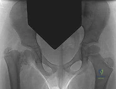 مقارنة خيارات العلاج للفحج الرضخي