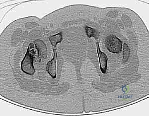 الفحج الرضخي النمائي عند الأطفال: دليل شامل للتشخيص والعلاج بتقويم الفحج مع الأستاذ الدكتور محمد هطيف