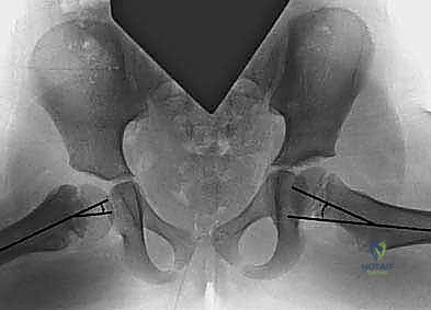 خطوات جراحة تقويم الفحج