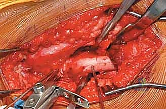 أعراض وعلامات الفحج الرضخي النمائي