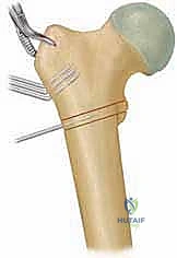 التشريح الجراحي لورك الطفل