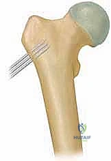 صورة توضيحية لـ الفحج الرضخي النمائي عند الأطفال