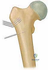 الفحج الرضخي النمائي وزاوية هيلجنراينر