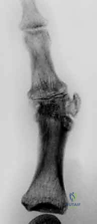 العلاج الطبيعي وتأهيل اليد بعد زراعة مفصل السيليكون