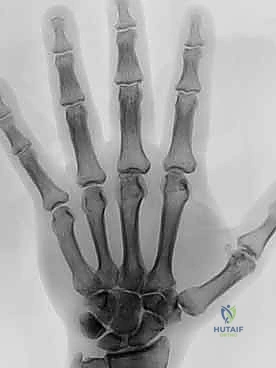 قياس حجم المفصل الصناعي المناسب للمريض