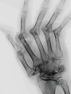الخطوة الأولى: فتح المفصل التالف وإزالة الزوائد العظمية