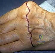 جراحة مفصل السيليكون لليد: دليل شامل لاستعادة حركة الأصابع مع الأستاذ الدكتور محمد هطيف في صنعاء