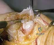 التشخيص الإشعاعي لتآكل مفاصل اليد