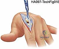 تشريح مفاصل اليد والأصابع وتأثير الروماتويد