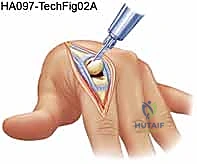 التخطيط الجراحي لاستبدال مفصل اليد