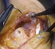 تشوهات الأصابع وانحراف المفاصل بسبب التهاب المفاصل