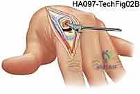 تجهيز المريض لجراحة اليد المجهرية في صنعاء