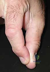 التأكد من استقرار المفصل وحركة الإصبع أثناء الجراحة