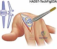 الأستاذ الدكتور محمد هطيف أثناء إجراء جراحة دقيقة