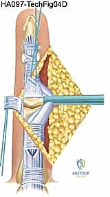 صورة توضيحية لـ جراحة مفصل السيليكون لليد: دليل شامل لاستعادة حركة الأصابع مع الأستاذ الدكتور محمد هطيف في صنعاء