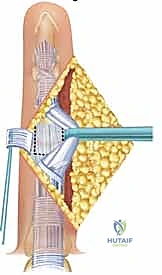 إدخال مفصل السيليكون بدقة داخل العظام