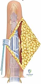 تحضير القناة العظمية لاستقبال دعامة السيليكون