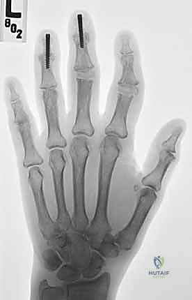 Intraoperative Surgical Step