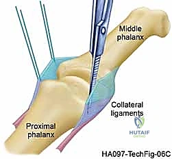 Illustration of silicone implant arthroplasty - Dr. Mohammed Hutaif