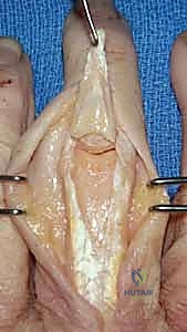 صورة توضيحية لـ جراحة مفصل السيليكون لليد: دليل شامل لاستعادة حركة الأصابع مع الأستاذ الدكتور محمد هطيف في صنعاء