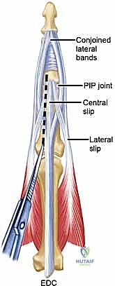 إصلاح الأربطة والأوتار المحيطة بالمفصل الجديد
