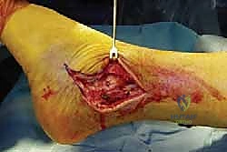 Transfibular Ankle Arthrodesis: An Intraoperative Masterclass for End-Stage Arthritis