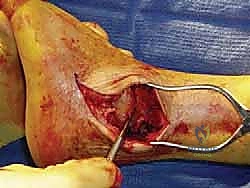 صورة طبية: دمج مفصل الكاحل عبر الشظية: حل جذري لالتهاب المفاصل المتقدم مع الأستاذ الدكتور محمد هطيف