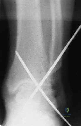 دمج مفصل الكاحل عبر الشظية: حل جذري لالتهاب المفاصل المتقدم مع الأستاذ الدكتور محمد هطيف